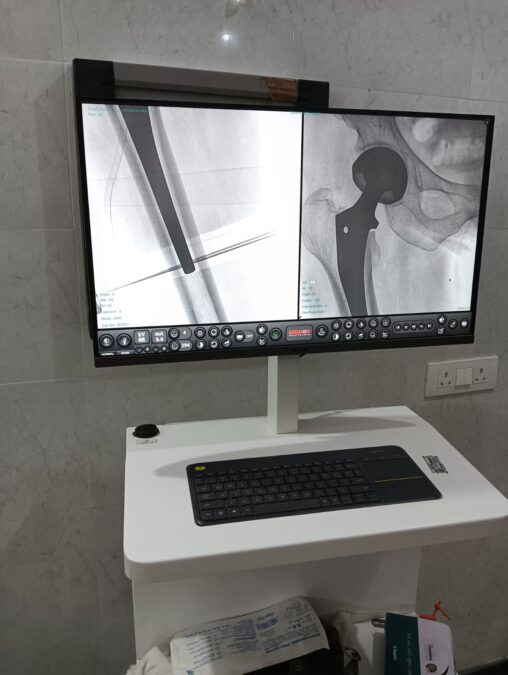 प्रियदर्शनी अस्पताल में हिप जॉइंट का सफल प्रत्यारोपण, मरीज को मिला नया जीवन