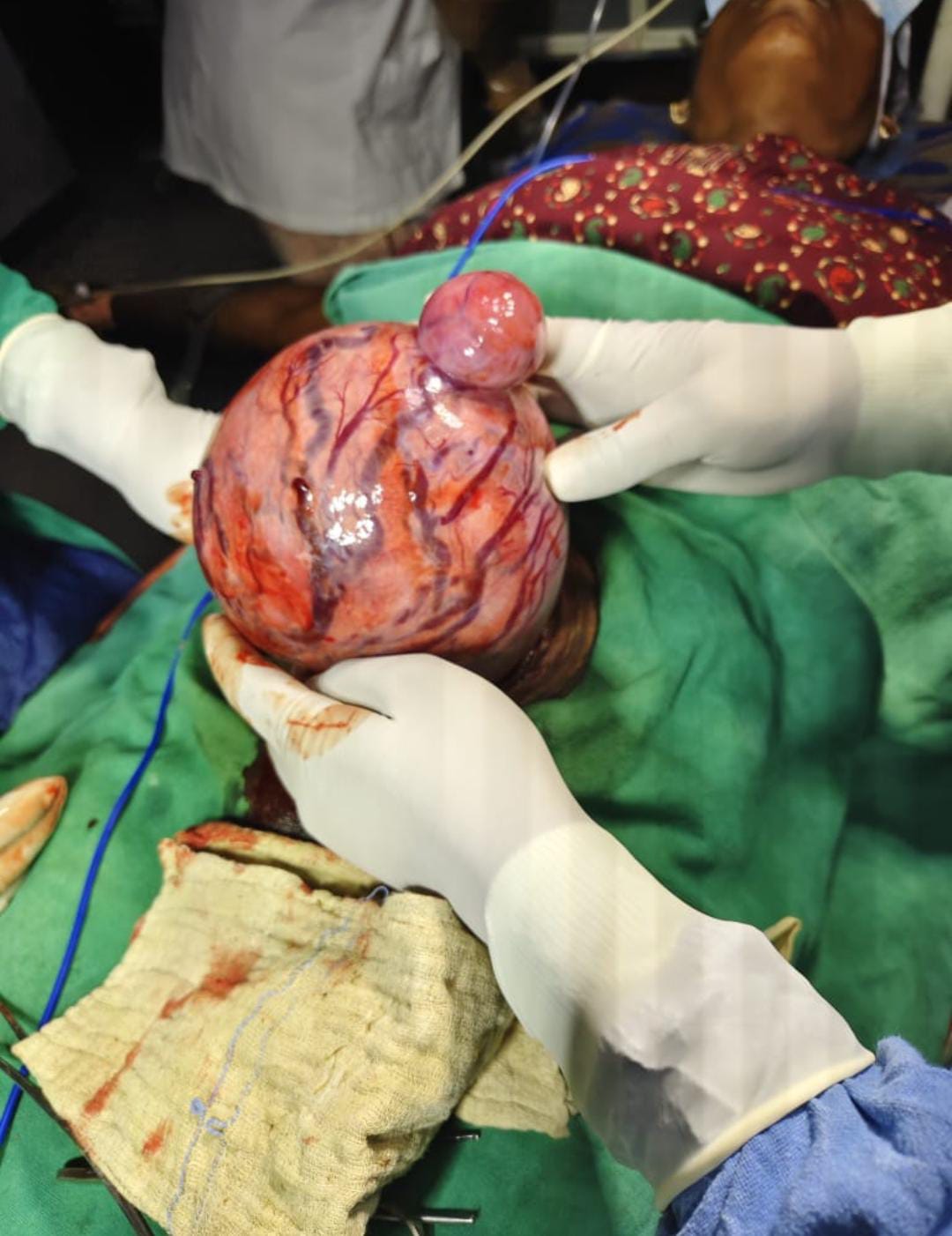 गंगा हॉस्पिटल में मरीज का हुआ सफल ऑपरेशन 5 किलो का फाइबर यूटेरस को सफलतापूर्वक निकाला गया